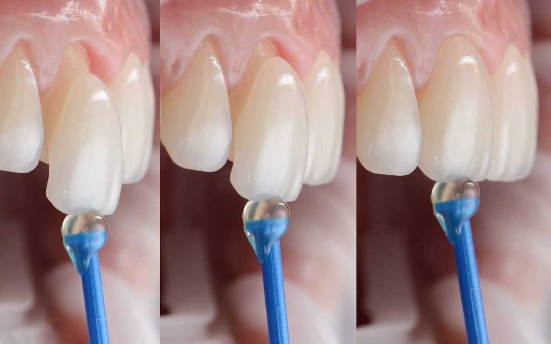 Tratamientos de odontología estética: transforma tu sonrisa con las carillas dentales