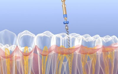 ¿Qué es un tratamiento de endodoncia?