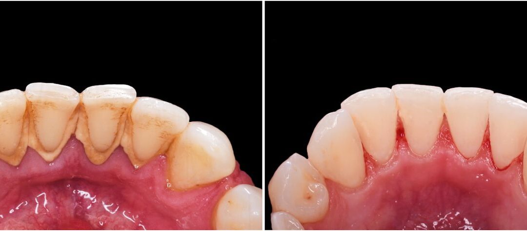 Todo lo que necesitas saber sobre la placa dental: su impacto en la salud bucodental