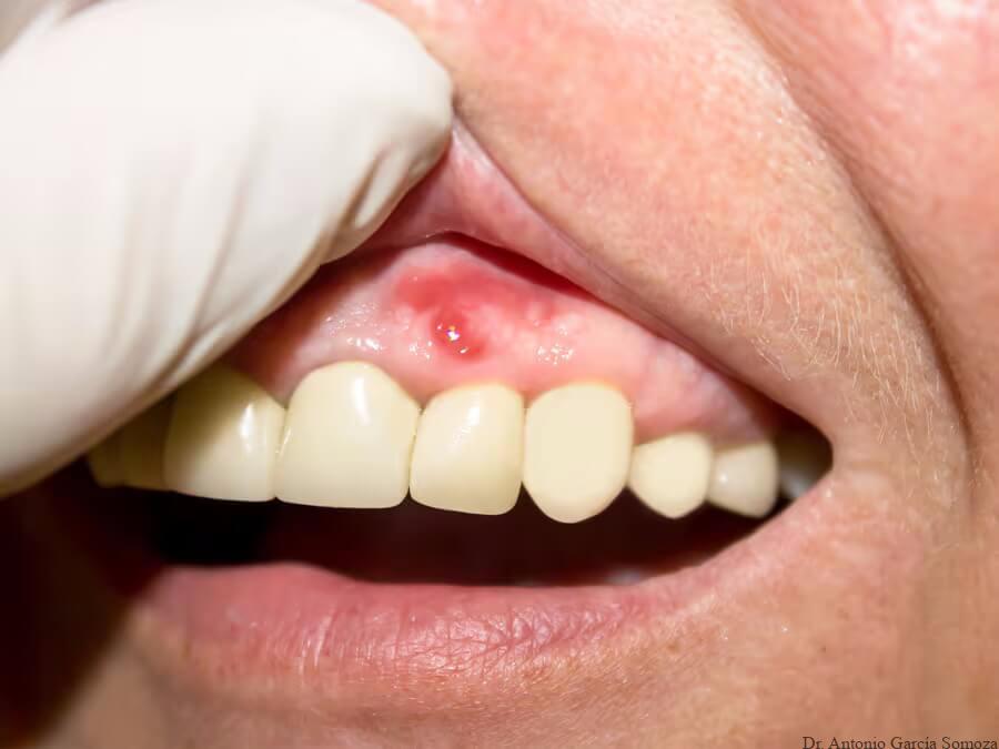 ¿Qué es una fístula dental? Causas, síntomas y tratamiento
